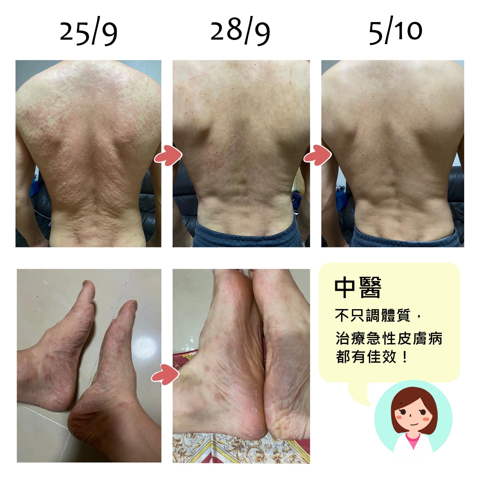 病例分享-急性食物過敏2 中醫不只調體質